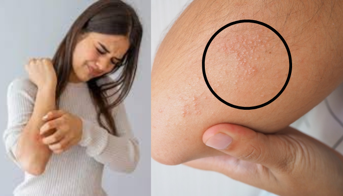 Read more about the article Heat Rash Prevention |கோடை வேர்க்குரு வேதனை நீங்க!