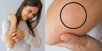 Heat Rash Prevention
